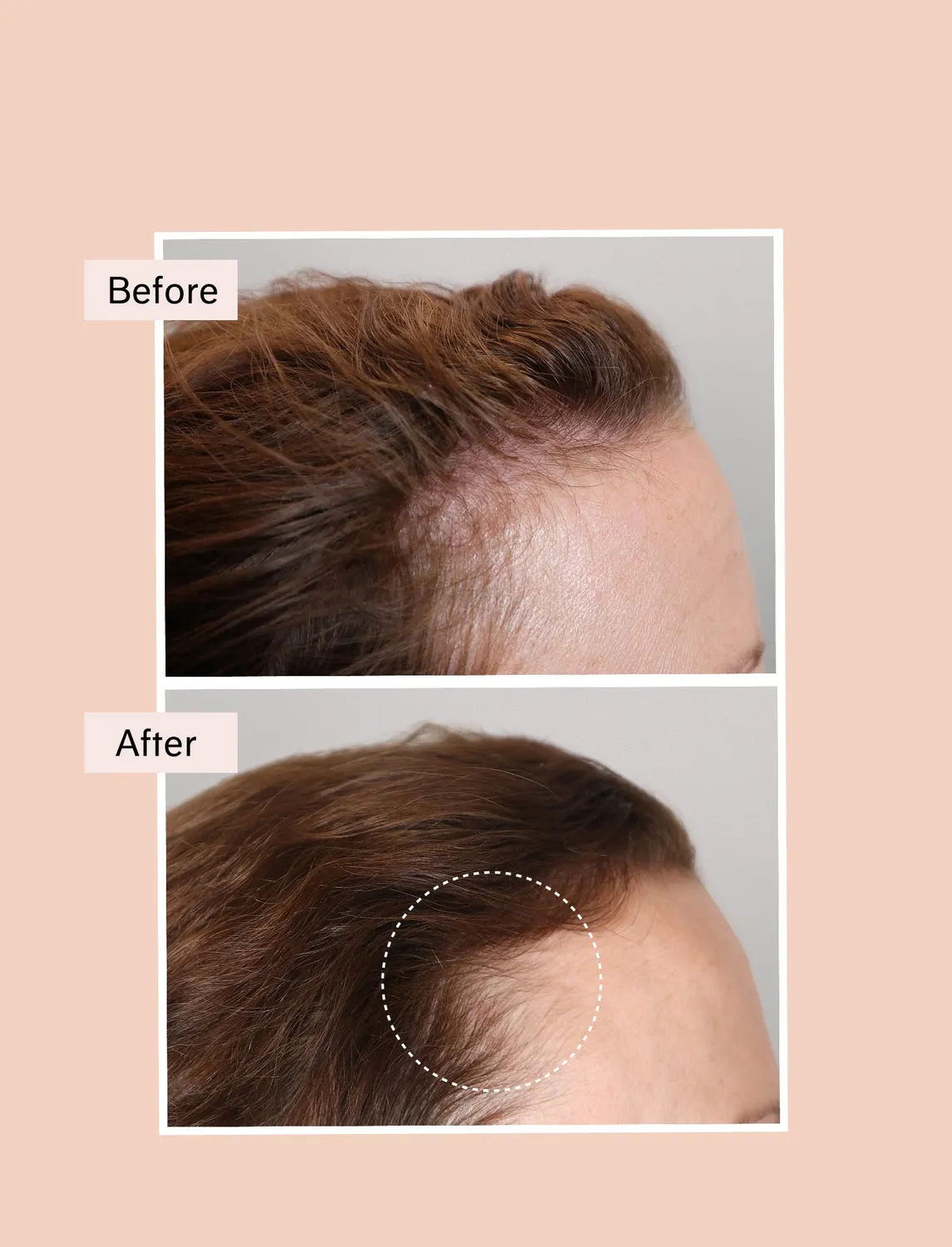Chāmpo Pitta Growth Serum Trio haargroei serum 3-pack dun haar