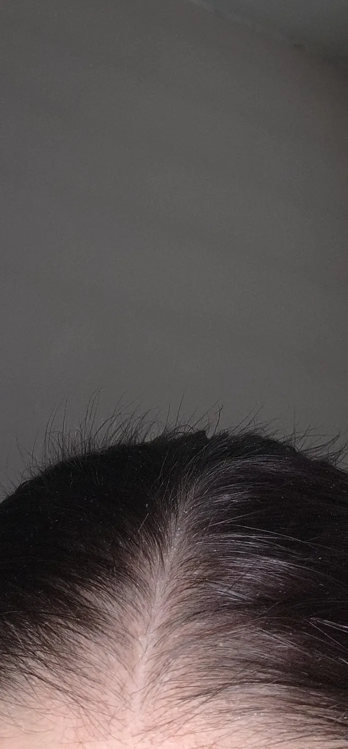 Chāmpo Growth System haarset fijn haar haaruitval